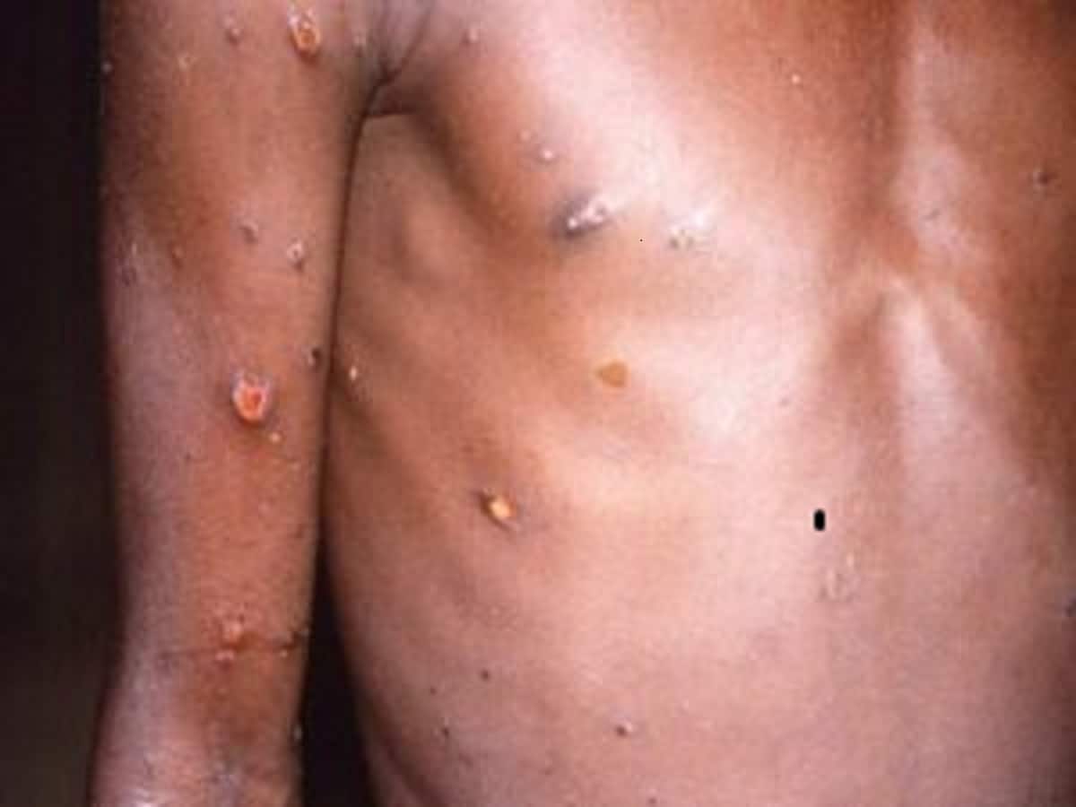 Does COVID-19 Infection Increase Your Risk Of Monkeypox: What Experts Say